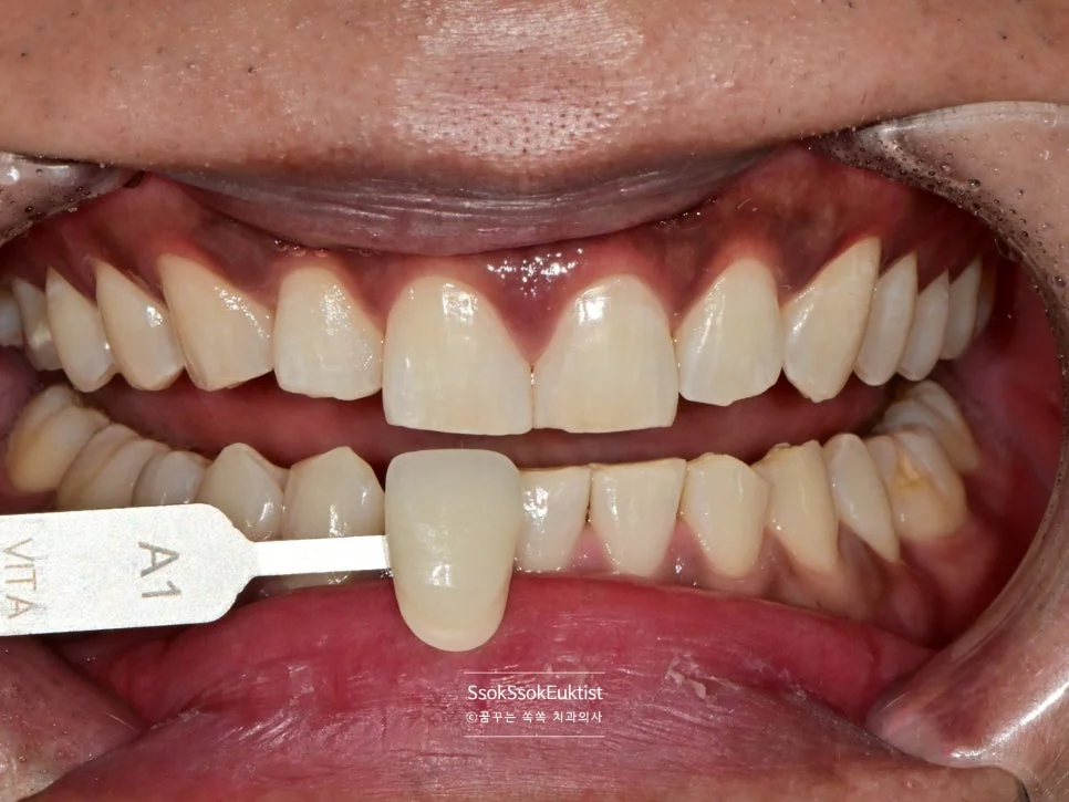 원데이 미백 증례3 시술 후 쉐이드 가이드 A1 비교