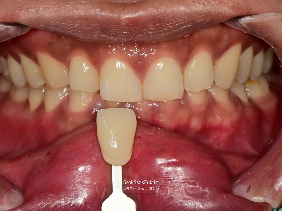 원데이 미백 증례3 시술 전 쉐이드 가이드 A3 비교