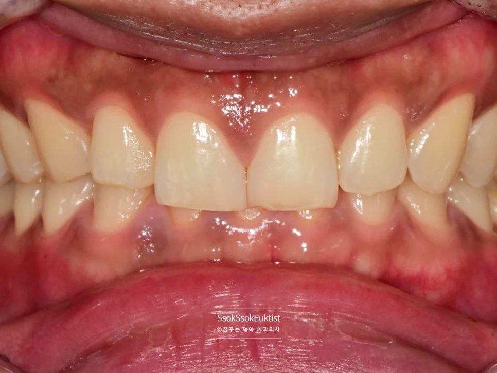 원데이 미백 증례3 시술 전 상악 전치부 A3 쉐이드