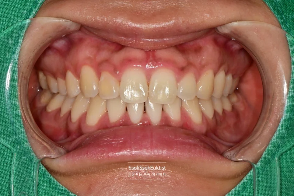 원데이 미백 증례4 1차 시술 후 앞니만 A2 근처