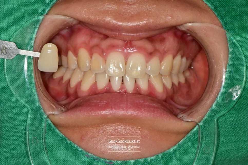 원데이 미백 증례4 1차 시술 후 쉐이드 가이드 A2 비교