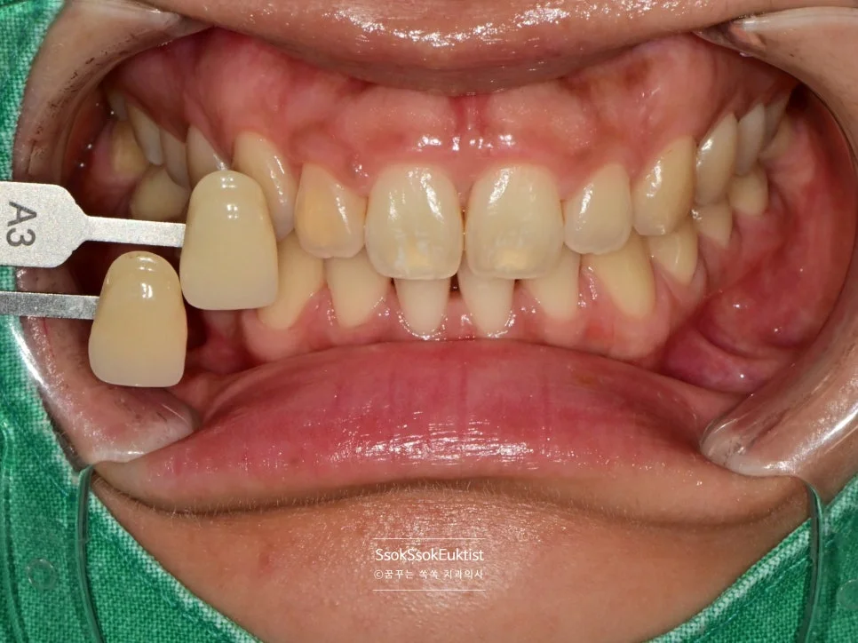 원데이 미백 증례4 시술 전 쉐이드 가이드 A3 비교