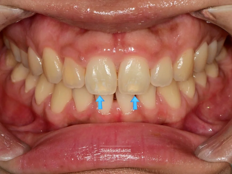 원데이 미백 증례4 시술 전 상악 전치부 A3 높은 투명도