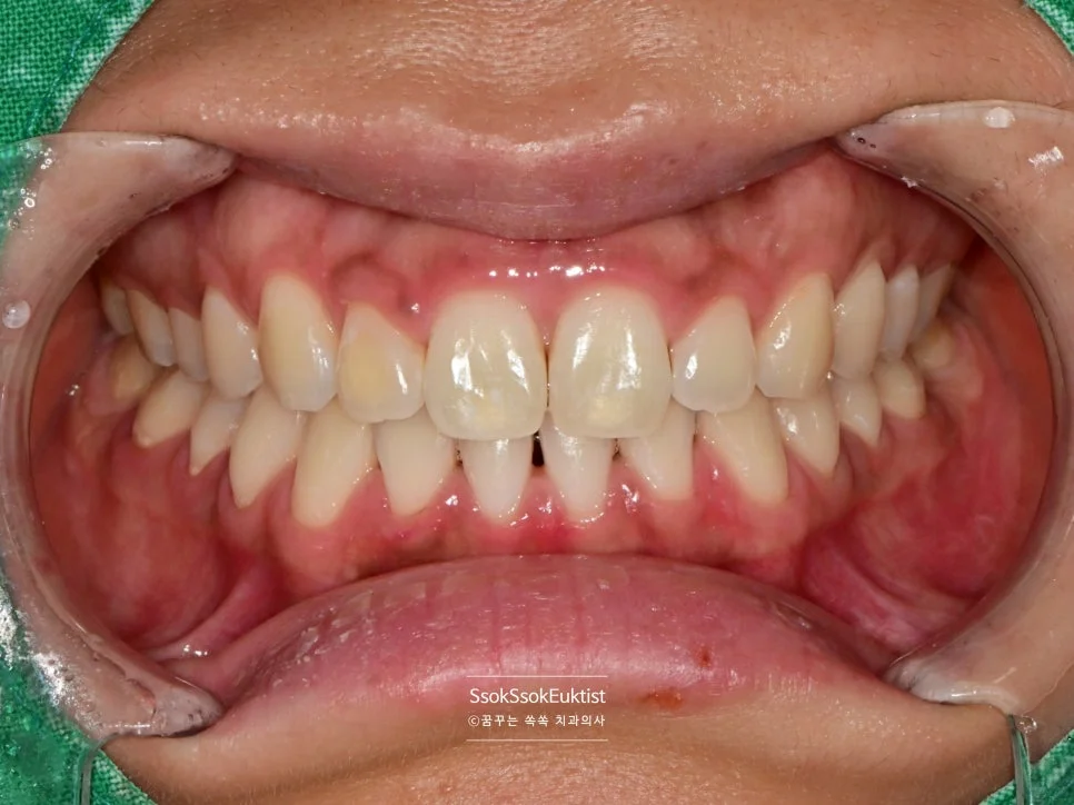 원데이 미백 증례4 추가 미백 후 최종 결과 A1 근처