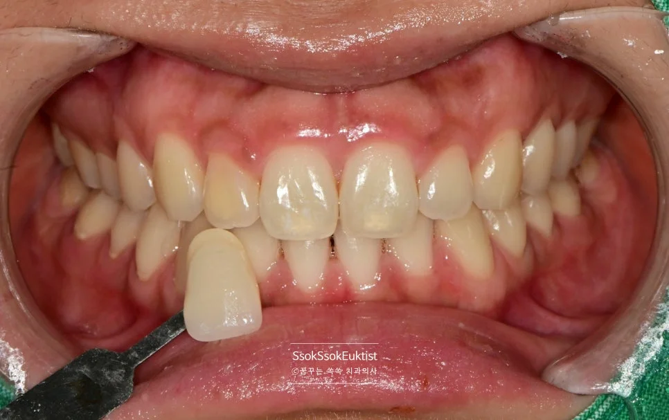 원데이 미백 증례4 2주 후 경과 관찰 상세