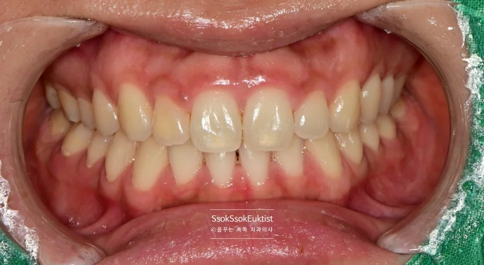 원데이 미백 증례4 2주 후 경과 관찰 색상 유지