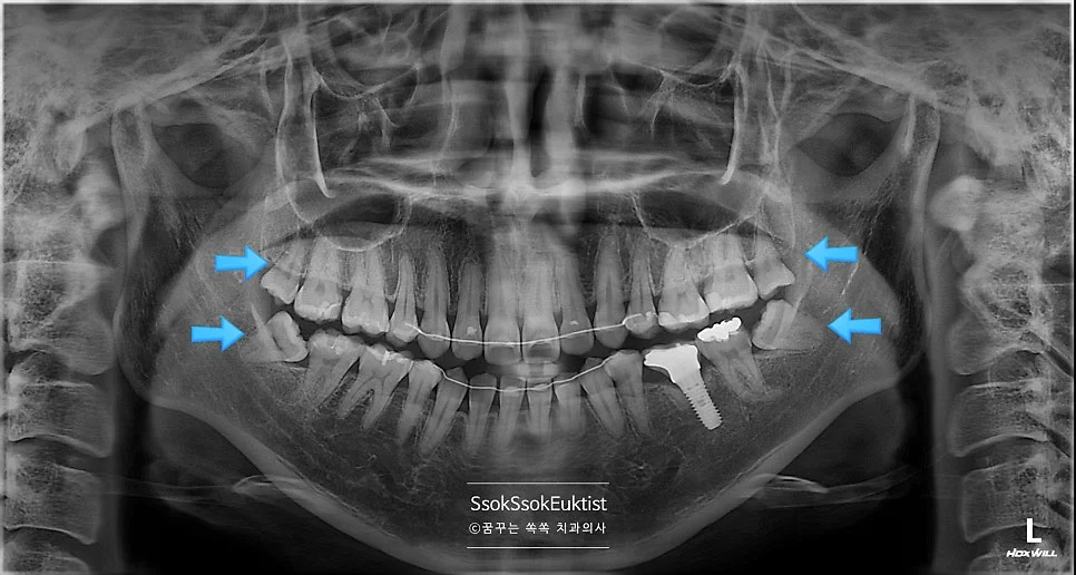 구강 전체 사랑니 4개 진단 사진