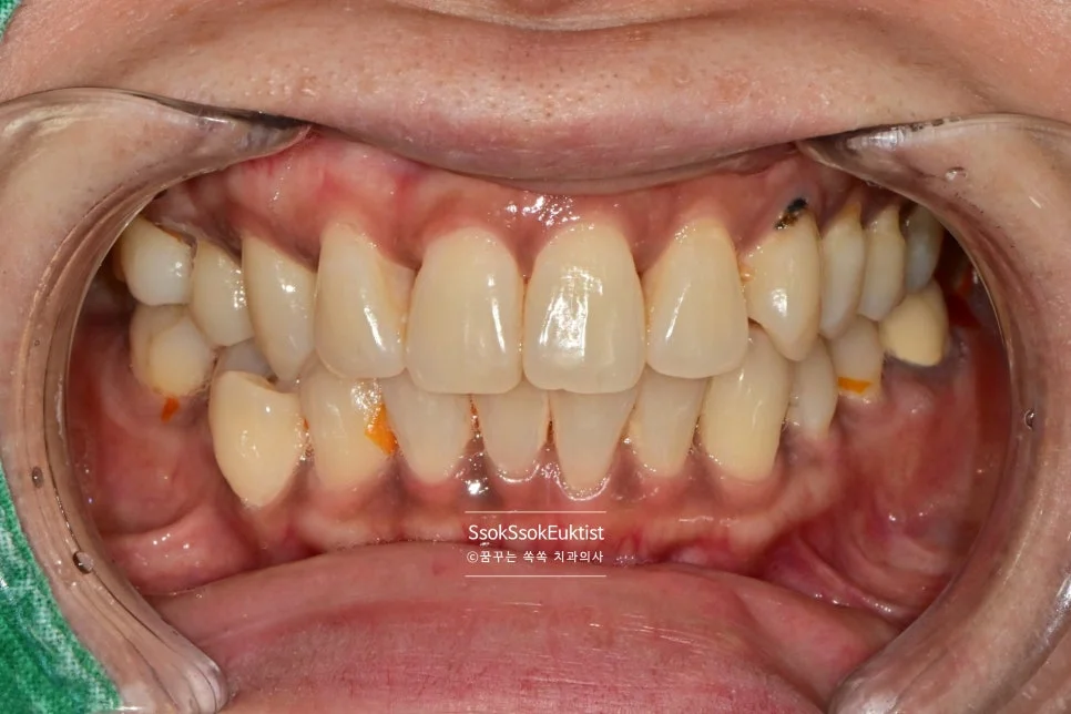 스케일링 전 구강 정면 임상 사진