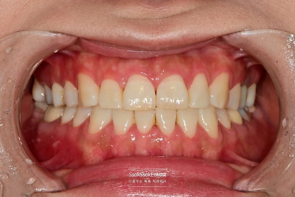 충치 치료 전 구강 정면 임상 사진