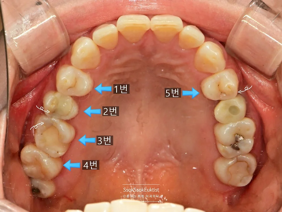 충치 위치 표시 구강 사진 치아 번호