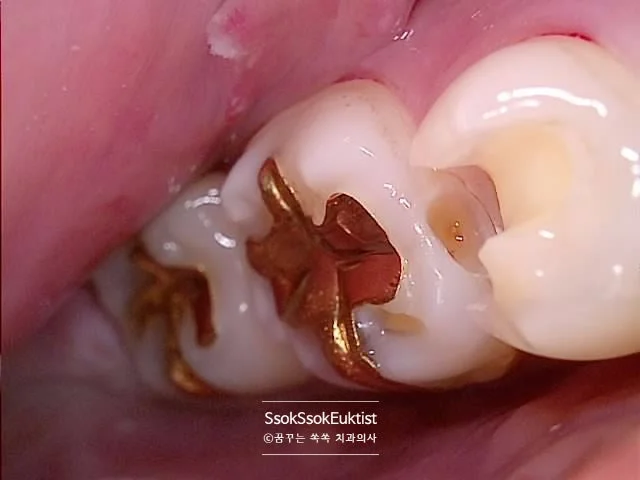 인접 치아 충치 레진 치료 구강 사진