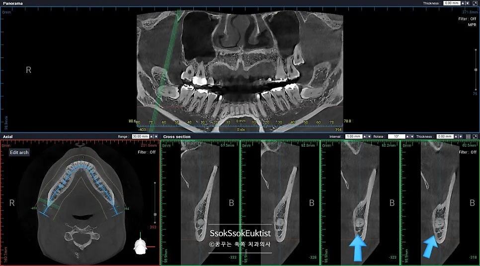 우측 하악 사랑니 CBCT 3D 영상 신경관 위치 확인