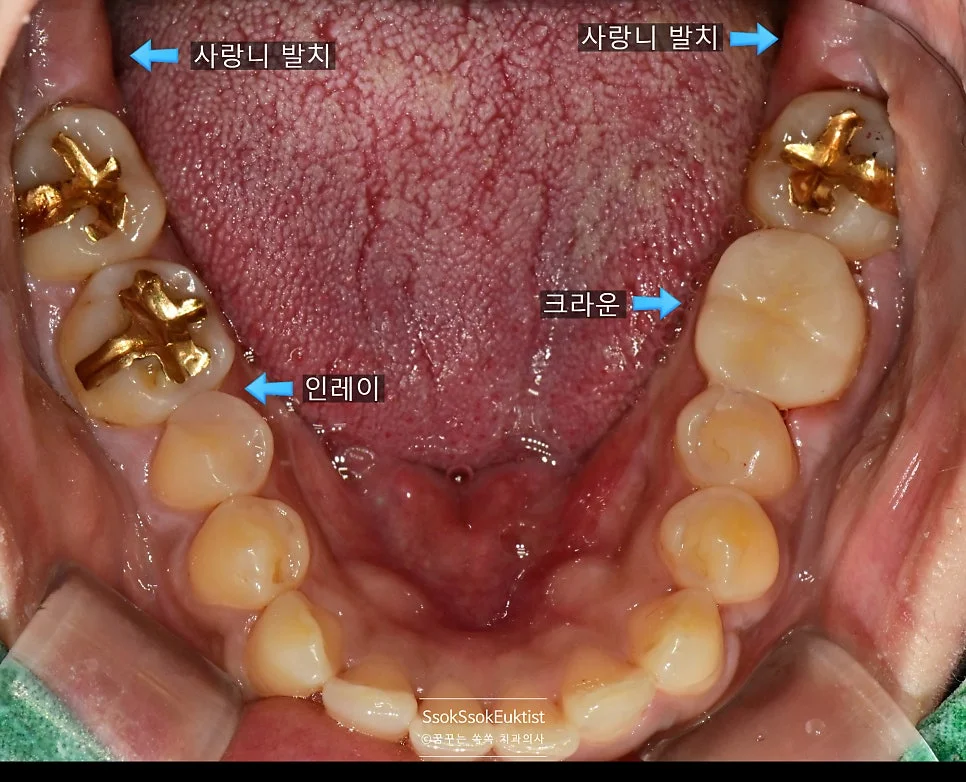 최종 결과 상하악 교합 사진 전체 치료 완료