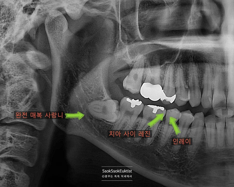 1회차 수면마취 우측 사랑니 근접 엑스레이 신경관 확인