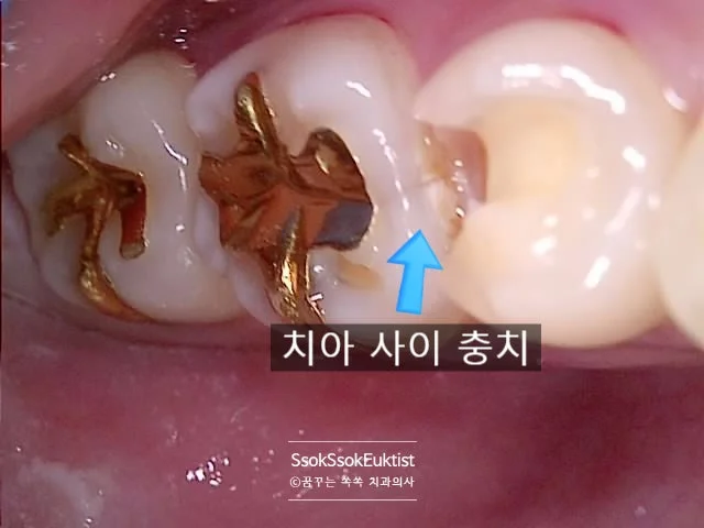 인레이 삭제 후 인접면 충치 확인 구강 사진