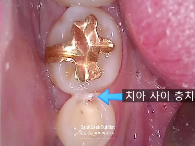 인레이 삭제 중 치아 사이 충치 기록 구강 사진