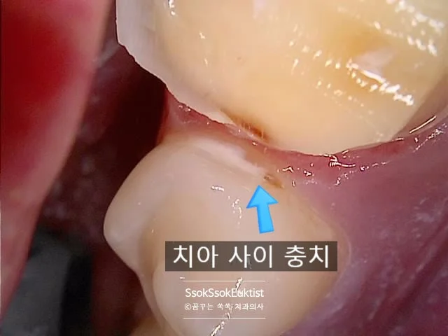 왼쪽 아래 5번 치아 충치 기록 구강 사진