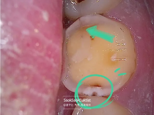 왼쪽 아래 6번 치아 사이 충치 기록 구강 사진