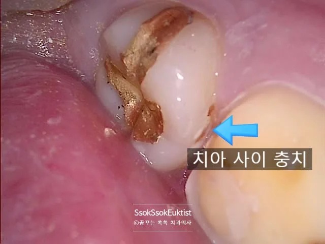 왼쪽 아래 7번 치아 충치 기록 구강 사진