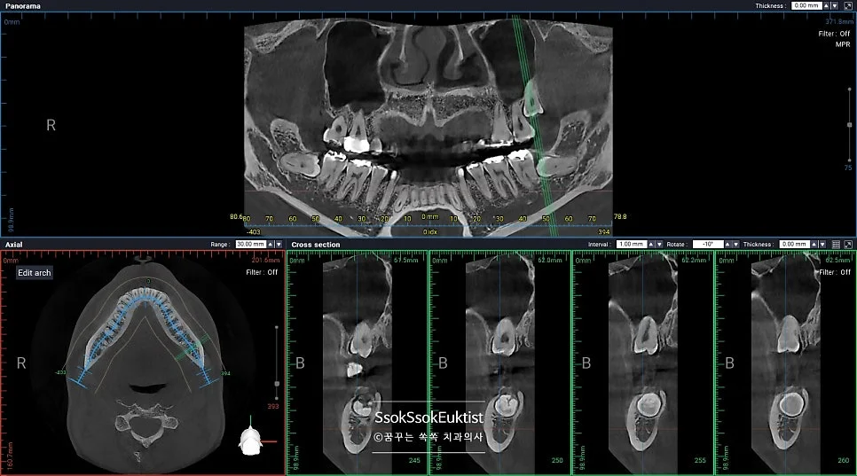 왼쪽 하악 매복 사랑니 CBCT 3D 영상 신경관 인접