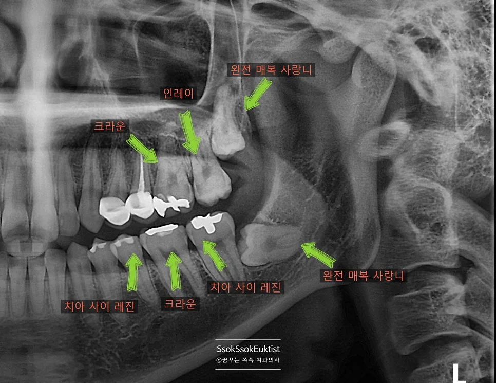 2회차 수면마취 왼쪽 치료 계획 엑스레이 화살표 표시