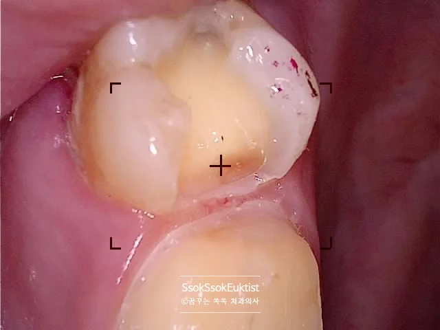 왼쪽 위 7번 치아 인레이 삭제 구강 사진