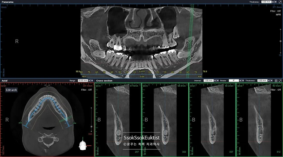 왼쪽 상악 매복 사랑니 CBCT 3D 영상 상악동 확인