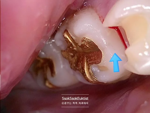 치아 사이 레진 충전 완료 구강 사진