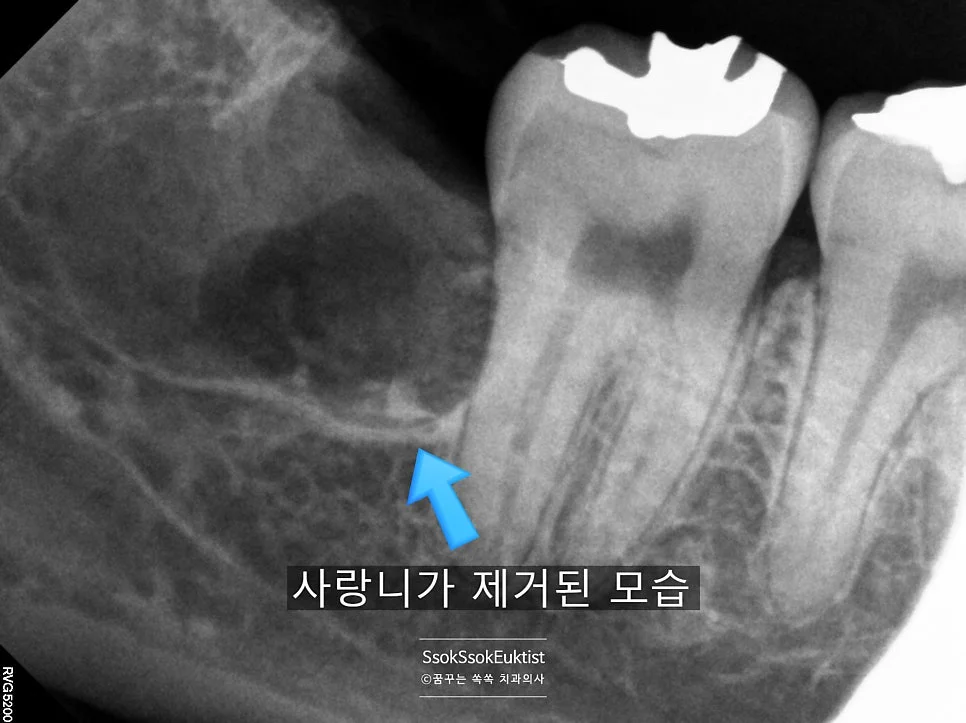 우측 하악 매복 사랑니 근접 엑스레이 신경관 인접