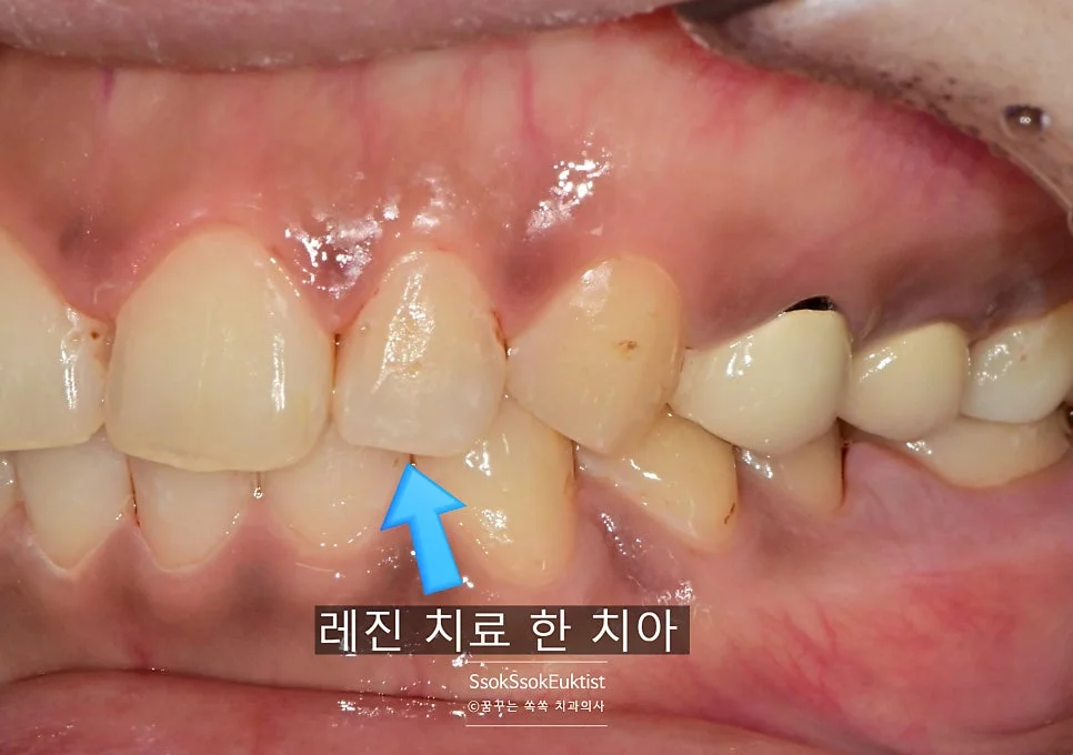 상악 전체 치료 완료 후 구강 사진 레진 인레이 크라운