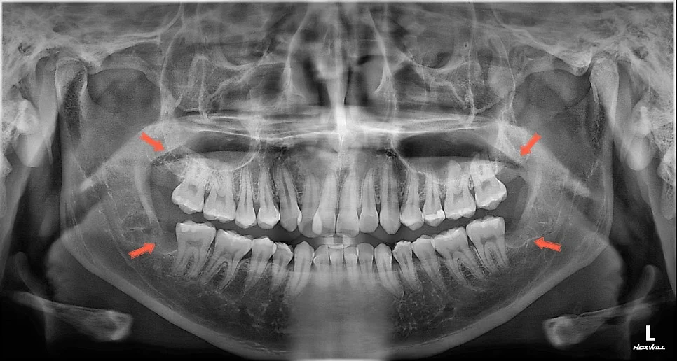 사랑니 4개 발치 완료 최종 파노라마