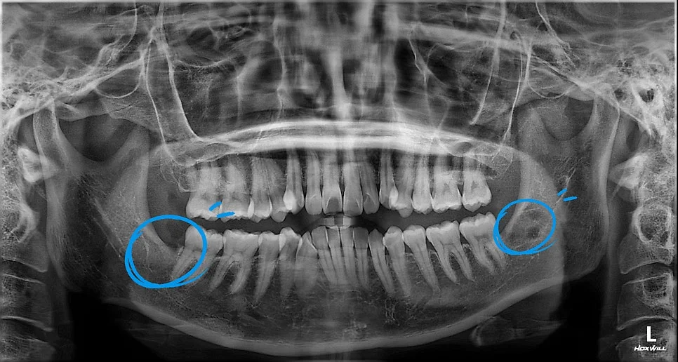 양쪽 사랑니 발치 후 파노라마 제2대구치 보존 확인