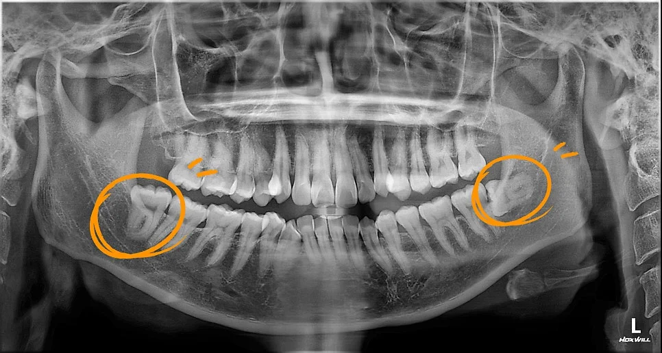 파노라마 X-ray 양쪽 아래 매복 사랑니 진단