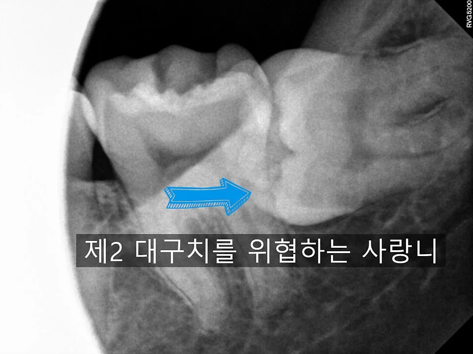 왼쪽 아래 매복 사랑니 제2대구치 압박 확대