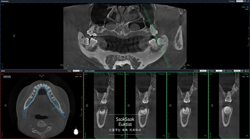 파노라마 왼쪽 아래 매복 사랑니 진단 X-ray