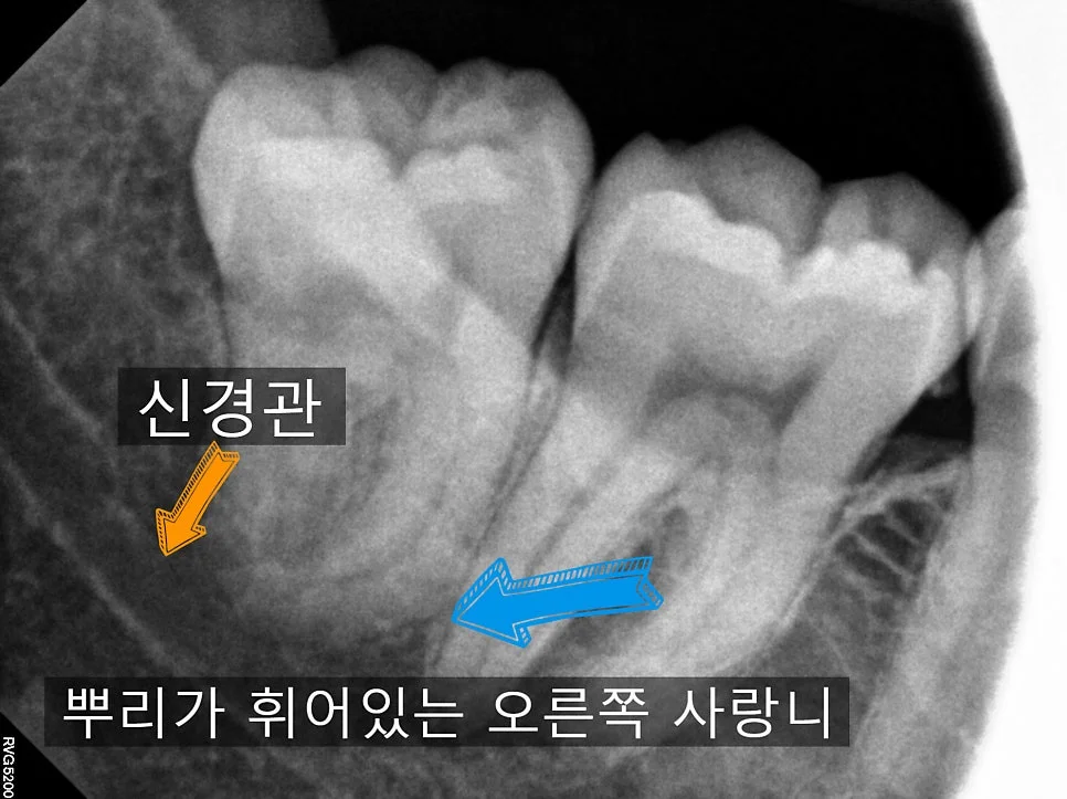 오른쪽 아래 사랑니 휜 뿌리 신경관 인접 확대