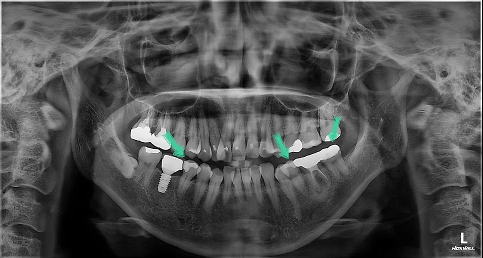 파노라마 사진 치료 계획 화살표 표시