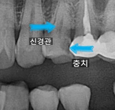 파노라마 엑스레이 충치 신경관 위치 확인