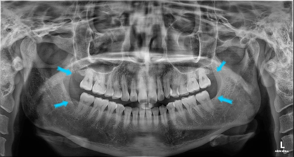 파노라마 X-ray 상하 양쪽 사랑니 4개 위치 표시
