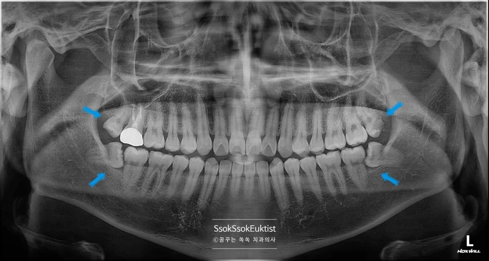 파노라마 방사선 사랑니 4개 위치