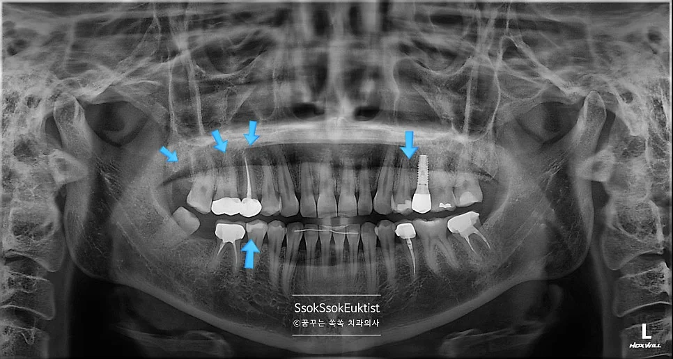 전체 구강 파노라마 방사선 사진