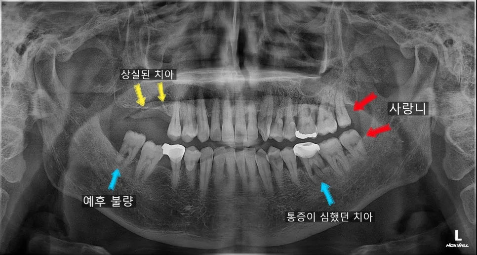 파노라마 엑스레이 만성 치주염 뼈 손실 진단