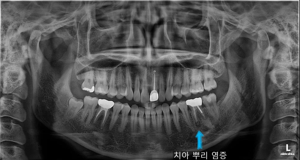 파노라마 엑스레이 치아 뿌리 끝 염증 진단 화살표 표시