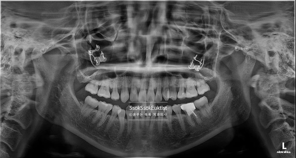 스케일링 진단 파노라마 방사선 사진