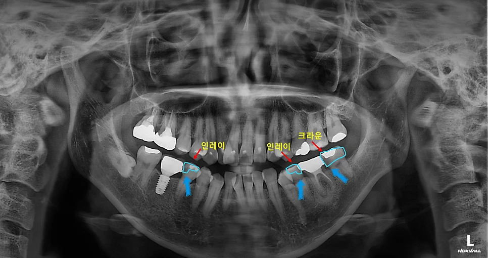 파노라마 방사선 사진 전체 치료 계획 표시