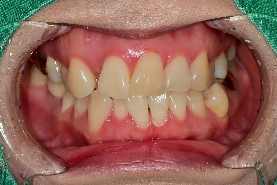 충치 검사 및 스케일링 내원 환자 초진 구강 사진
