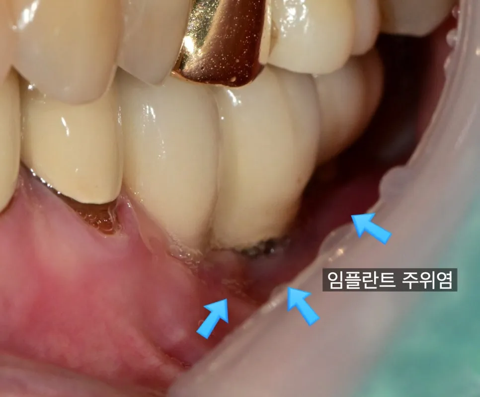 임플란트 주위염으로 인한 잇몸 염증 및 부착치은 감소 임상 사진