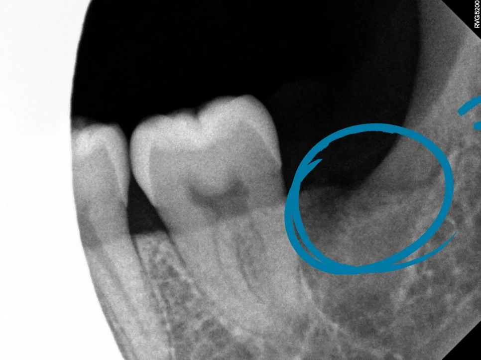 하악 반대쪽 사랑니 발치 후 제2대구치 보존 확인