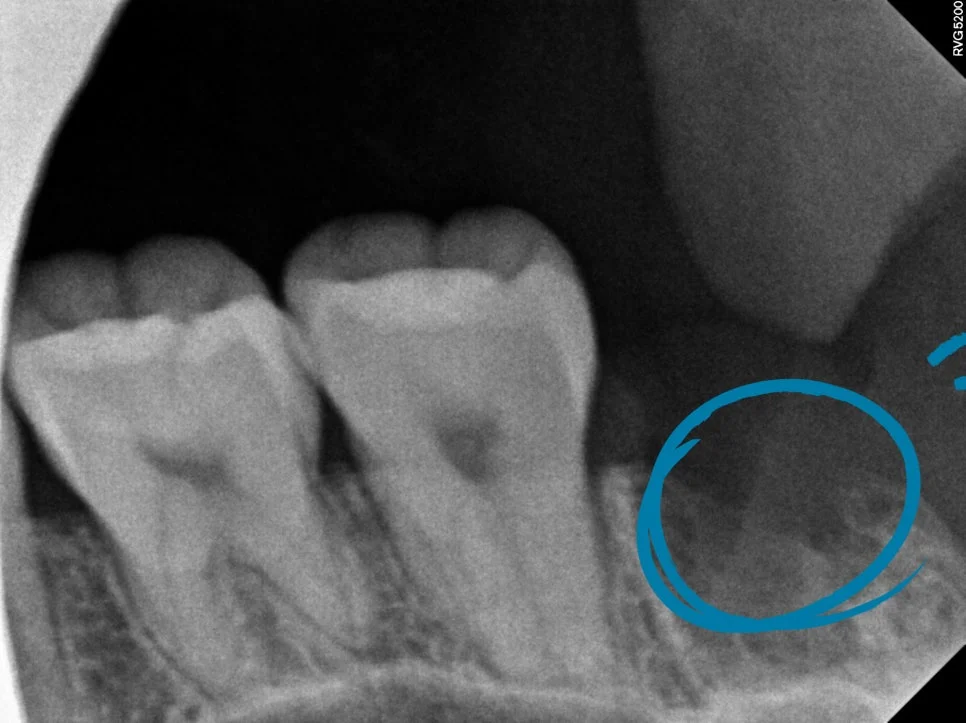 하악 사랑니 발치 후 제2대구치 보존 확인