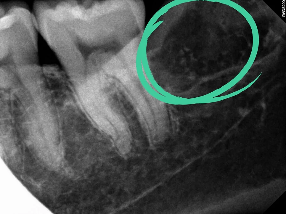 오른쪽 사랑니 발치 후 치근단 사진 잔뿌리 없음 확인